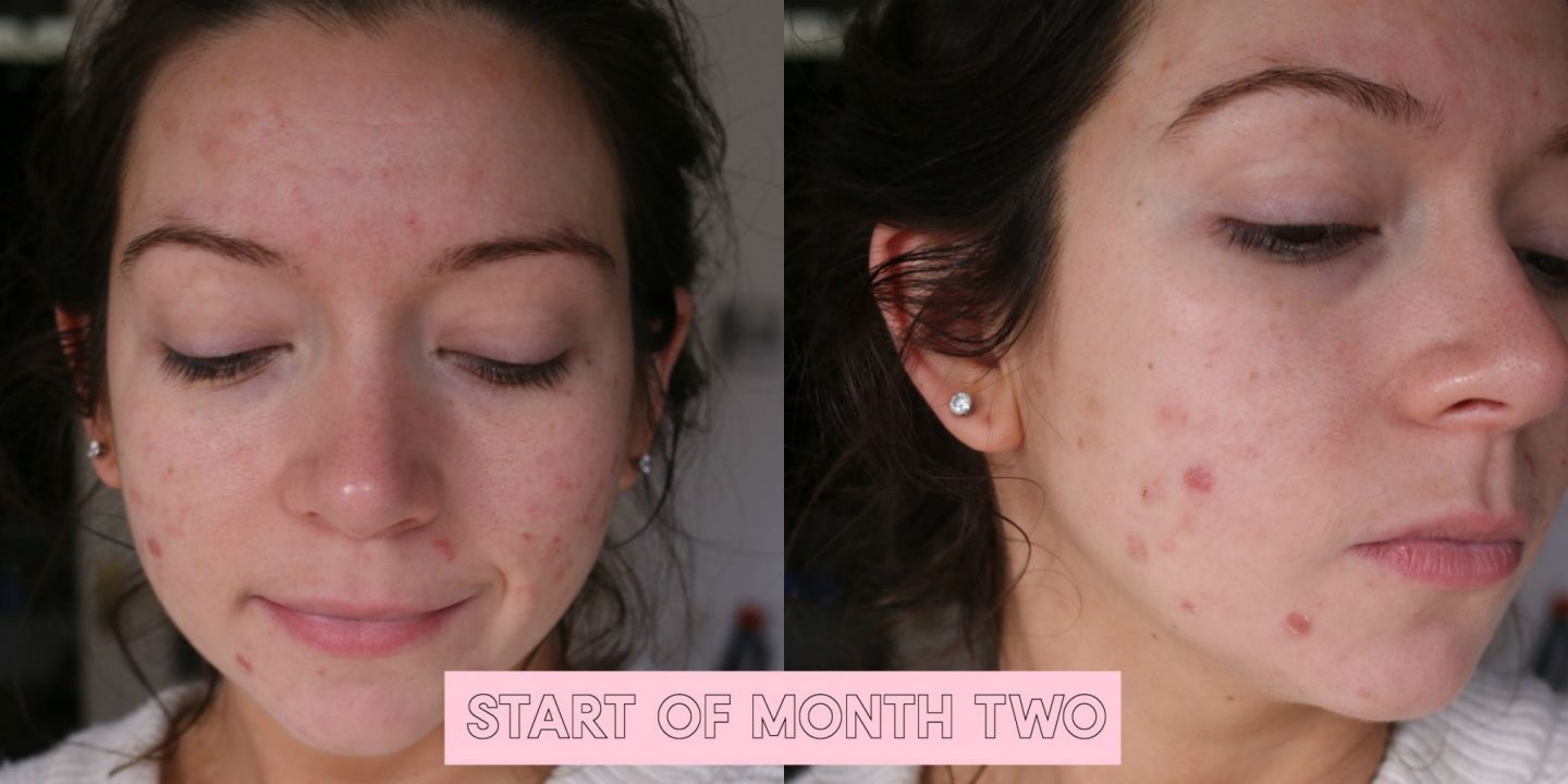 Roaccutane, accutane, roaccutane results, roaccutane diary, dizzybrunette3, acne, spots, how to get rid of acne, roaccutane before and after, roaccutane side effects